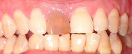 تغییر رنگ دندان ها بعد از عصب کشی, دلیل تغییر رنگ دندان بعد از عصب کشی, مصرف قهوه و تغییر رنگ دندان پس از عصب کشی