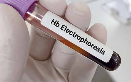 آزمایش الکتروفورز هموگلوبین خون, آزمایش الکتروفورز, آزمایش hb electrophoresis