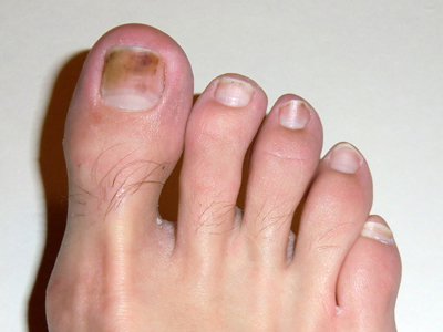 درمان سیاه شدن ناخن پا, علت سیاه شدن ناخن پا