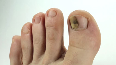 درمان سیاه شدن ناخن پا, علت سیاه شدن ناخن پا