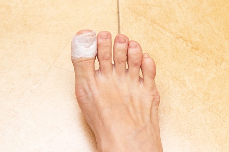 درمان خانگی عفونت ناخن پا, عسل برای عفونت انگشت پا, عفونت ناخن پا