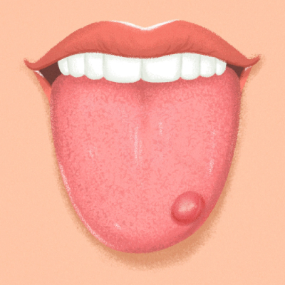 علت زخم زبان چیست, علل زخم زبان