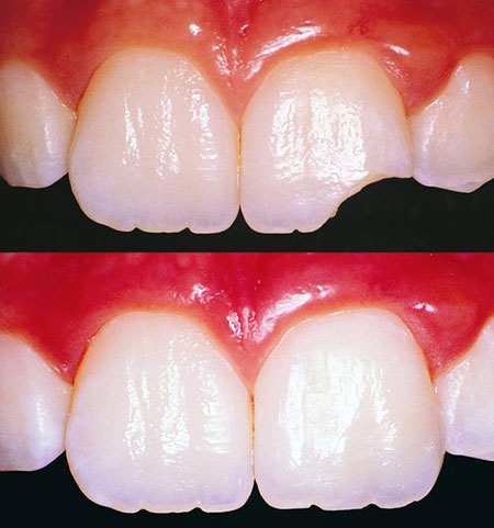 باندینگ دندان چیست؟, خطرات پیوند دندان