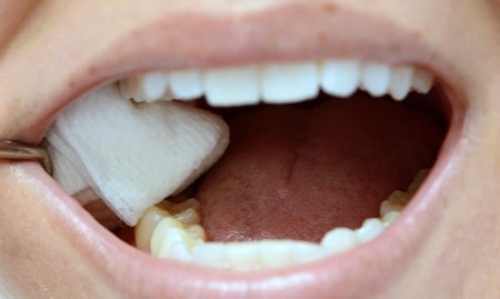 زمان برداشتن پانسمان موقت دندان, مواد تشکیل دهنده پانسمان دندان, مراقبت از دندان در هنگام پانسمان موقت