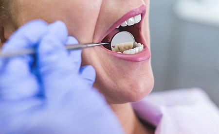 درمان حساسیت دندان,حساسیت دندان عصب کشی به گرما