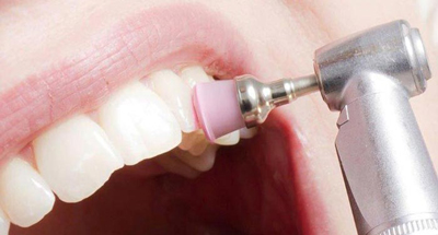 روش های انجام بروساژ دندان