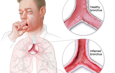 علایم و درمان برونشیت, برونشیت ریه چیست