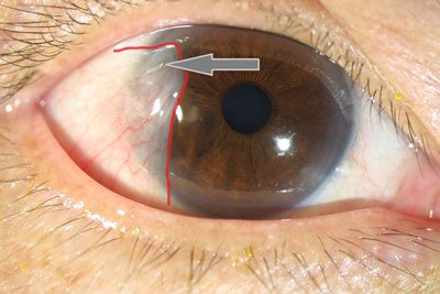 درمان سرطان چشم, تخلیه چشم