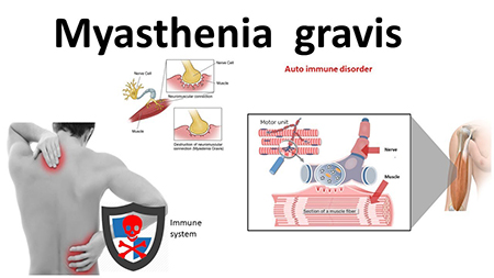 میاستنی گراویس درمان, بیماری میاستنی گراویس چیست