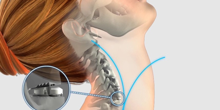 عمل جراحی برای درمان دیسک گردن
