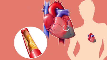 کاهش تری‌گلیسیرید, علائم چربی خون بالا