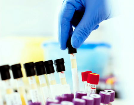 آزمایش سیتولوژی ادرار چیست, تشخیص سرطان مثانه با سیتولوژی ادرار