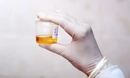 روش های نمونه گیری ادرار