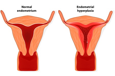 هیپرپلازی آندومتر, در مورد هیپرپلازی آندومتر, علت ایجاد هیپرپلازی آندومتر رحم