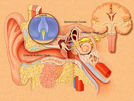  نوریت وستیبولار و لابیرنتیت, نوریت دهلیزی, التهاب گوش میانی