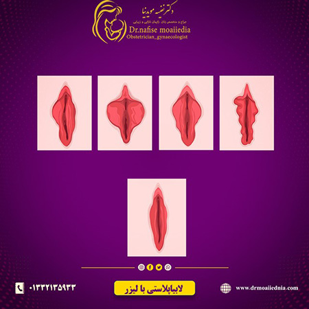 عمل لابیاپلاستی علت انجام لابیاپلاستی,دکتر نفیسه مویدنیا متخصص زنان رشت,جراحی زیبایی واژن