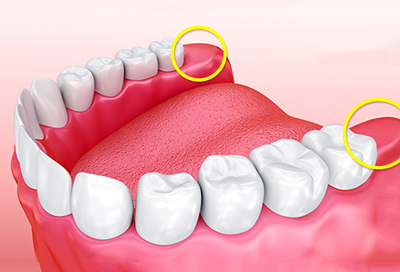 ترمیم دندان عقل, آیا درد دندان عقل طبیعی است