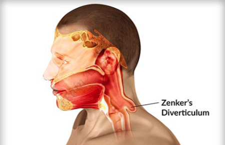 دیورتیکولوم زنکر اغلب در افراد مسن بالای ۶۰ سال رخ میدهد دیورتیکولوم زنکر, اختلال بلع در سالمندان