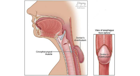 در موارد کوچک و بدون علامت، نیازی به درمان نیست دیورتیکولوم زنکر, اختلال بلع در سالمندان