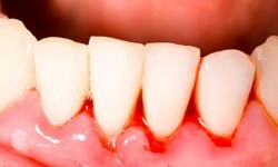 بیماری لثه،اخبار پزشکی ،خبرهای پزشکی بیماری لثه,اخبار پزشکی ,خبرهای پزشکی