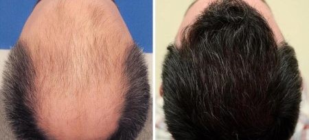 کلینیک فوق تخصصی ایران نوین کاشت مو,کلینیک کاشت مو,کلینیک فوق تخصصی ایران نوین
