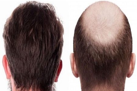 کلینیک کاشت مو کاشت مو,کاشت موی طبیعی,کلینیک فوق تخصصی ایران نوین