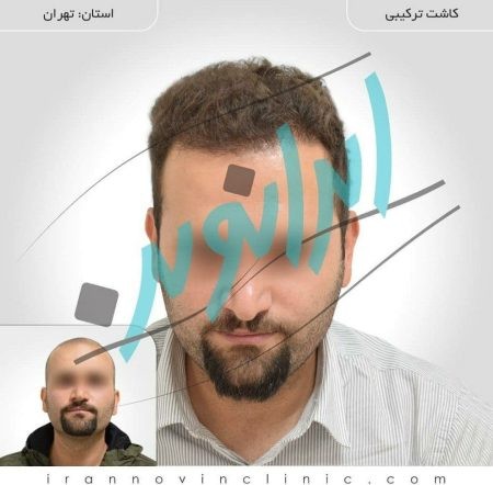 کاشت موی طبیعی کاشت مو,کاشت موی طبیعی,کلینیک فوق تخصصی ایران نوین