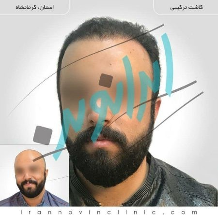 کاشت مو در ایران نوین کاشت مو,کاشت مو در ایران نوین,کلینیک فوق تخصصی ایران نوین