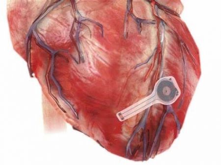 ضربان ساز قلب،اخبار پزشکی،خبرهای پزشکی
