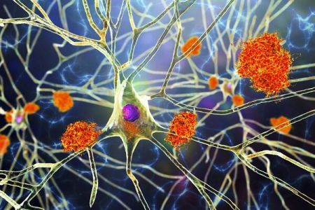 آلزایمر،اخبار پزشکی،خبرهای پزشکی آلزایمر،اخبار پزشکی،خبرهای پزشکی