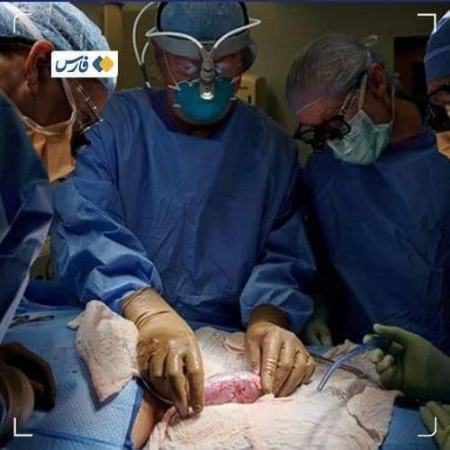 پیوند کلیه خوک به انسان,اخبار پزشکی ,خبرهای پزشکی