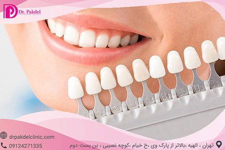 لامینیت دندان کامپوزیت دندان چیست,تفاوت کامپوزیت و لامینیت,کامپوزیت دندان