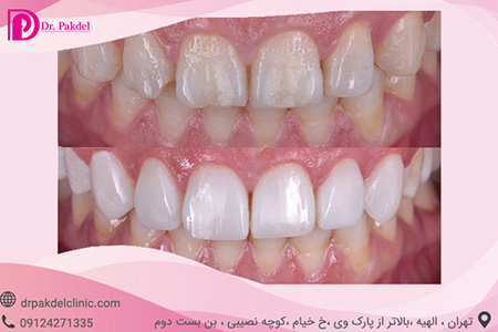 نحوه ی از بین بردن بد رنگی دندان لامینیت دندان, بلیچینگ دندان, عصب کشی دندان