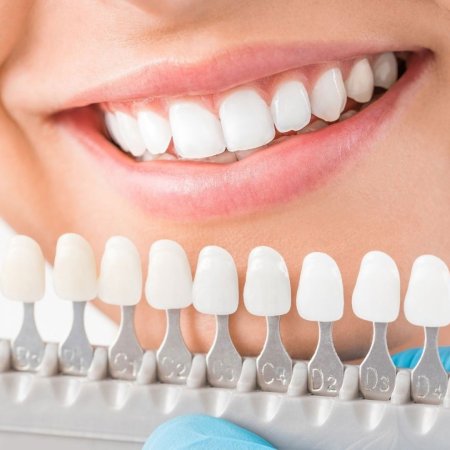 مراقبت از کامپوزیت دندان,افزایش طول عمر کامپوزیت