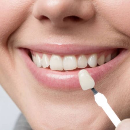 افزایش مراقبت از کامپوزیت دندان,افزایش طول عمر کامپوزیت