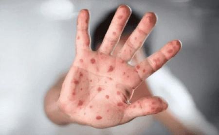 آبله میمون ،اخبار پزشکی ،خبرهای پزشکی آبله میمون,اخبار پزشکی ,خبرهای پزشکی