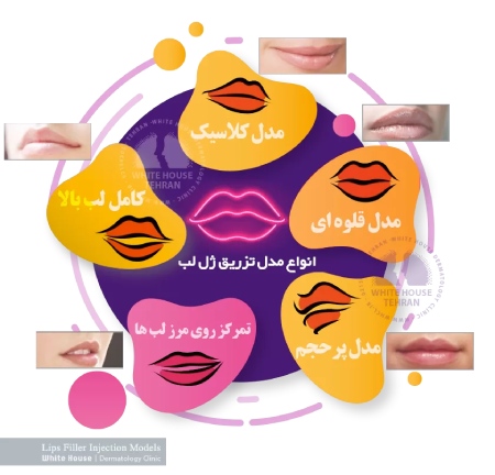 اینفوگرافی انواع مدل تزریق ژل به لب ها تزریق ژل لب روسی,مدل های تزریق ژل لب,تزریق ژل لب مدل قلبی