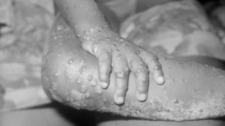 آبله میمون،اخبار پزشکی ،خبرهای پزشکی آبله میمون,اخبار پزشکی ,خبرهای پزشکی