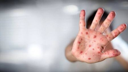 آبله میمون ،اخبار پزشکی ،خبرهای پزشکی آبله میمون,اخبار پزشکی ,خبرهای پزشکی