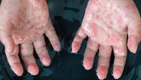 آبله میمون ،اخبار پزشکی ،خبرهای پزشکی آبله میمون,اخبار پزشکی ,خبرهای پزشکی