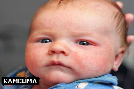 اگزما در نوزادان اطلاعاتی از بیماری های شایع در کودکان,درباره ی بیماری های شایع در کودکان, آبله مرغان در کودکان