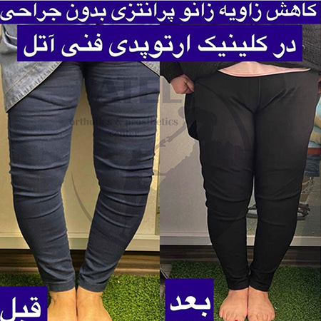 درمان زانوی ضربدری و ایکس روش های درمان زانوی پرانتزی و زانوی ایکس,قبل و بعد از درمان زانوی ایکس,زانوی پرانتزی یا زانوی ایکس