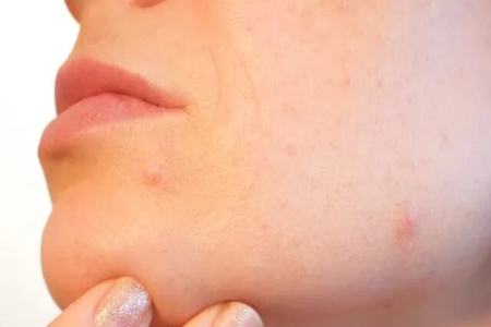 آکنهها،اخبار پزشکی ،خبرهای پزشکی آکنهها,اخبار پزشکی ,خبرهای پزشکی