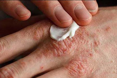 اگزما،اخبار پزشکی ،خبرهای پزشکی اگزما,اخبار پزشکی ,خبرهای پزشکی