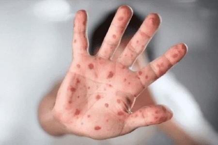آبله میمونی،اخبار پزشکی،خبرهای پزشکی آبله میمونی،اخبار پزشکی،خبرهای پزشکی