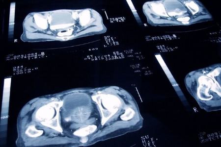 درمان سرطان پروستات با داروی کلسترول،اخبار پزشکی،خبرهای پزشکی