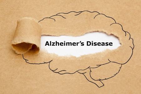  آلزایمر,اخبار پزشکی ,خبرهای پزشکی