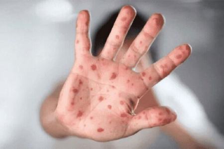 آبله میمونی،اخبار پزشکی ،خبرهای پزشکی آبله میمونی,اخبار پزشکی ,خبرهای پزشکی