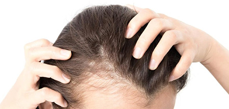 ریزش مو در خانم ها دلایل برای ریزش مو در خانم ها, برترین دلایل برای ریزش مو در خانم ها, دلیل هایی برای ریزش مو خانم ها