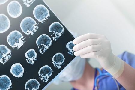 ضربه مغزی،اخبار پزشکی،خبرهای پزشکی ضربه مغزی،اخبار پزشکی،خبرهای پزشکی